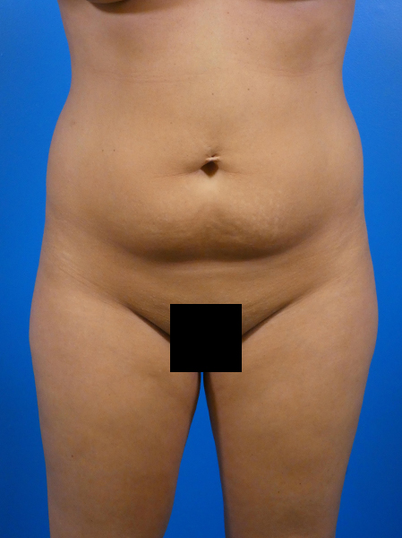 Tummy Tuck Before and After | Plastic Surgery Associates of Valdosta