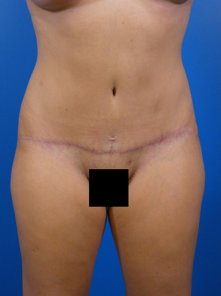 Tummy Tuck Before and After | Plastic Surgery Associates of Valdosta