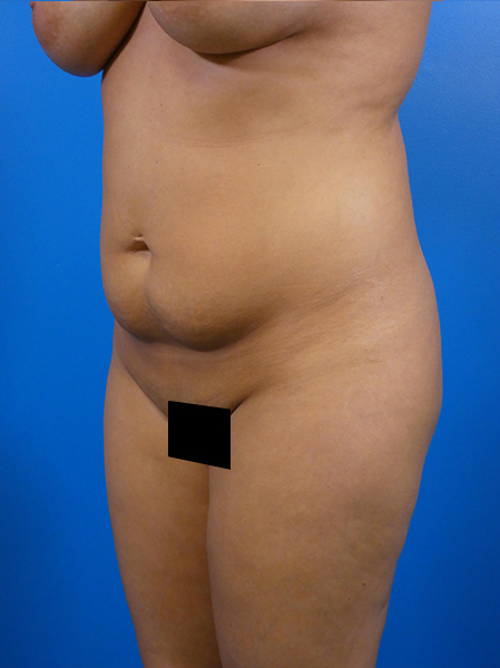 Tummy Tuck Before and After | Plastic Surgery Associates of Valdosta