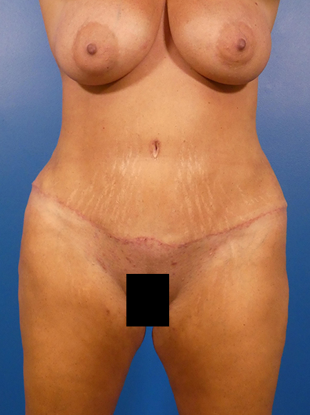 Tummy Tuck Before and After | Plastic Surgery Associates of Valdosta