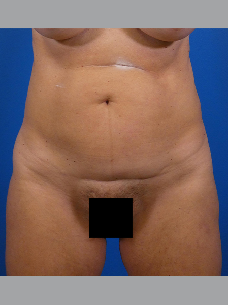 Tummy Tuck Before and After | Plastic Surgery Associates of Valdosta