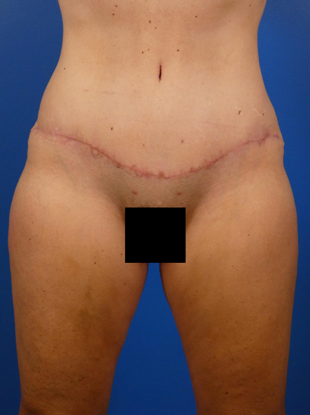 Tummy Tuck Before and After | Plastic Surgery Associates of Valdosta