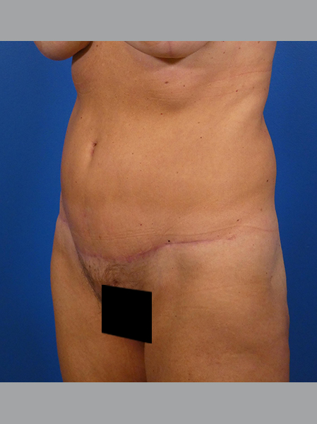 Tummy Tuck Before and After | Plastic Surgery Associates of Valdosta