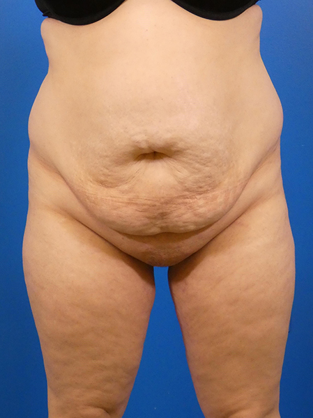 Tummy Tuck Before and After | Plastic Surgery Associates of Valdosta