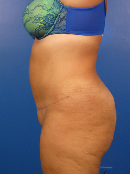 Tummy Tuck Before and After | Plastic Surgery Associates of Valdosta