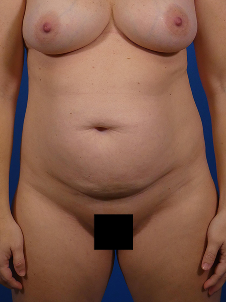 Tummy Tuck Before and After | Plastic Surgery Associates of Valdosta