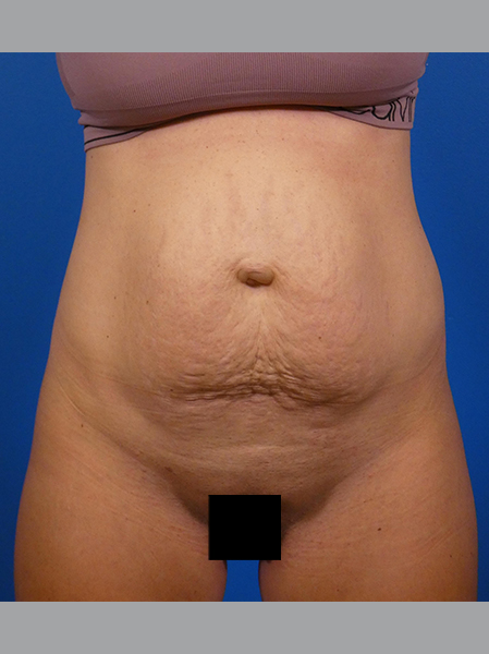 Tummy Tuck Before and After | Plastic Surgery Associates of Valdosta