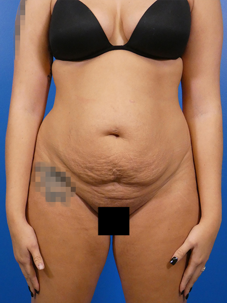 Tummy Tuck Before and After | Plastic Surgery Associates of Valdosta