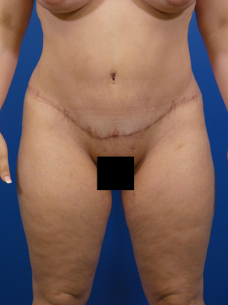 Tummy Tuck Before and After | Plastic Surgery Associates of Valdosta