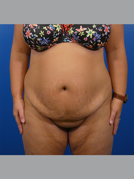 Tummy Tuck Before and After | Plastic Surgery Associates of Valdosta