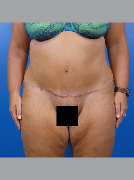 Tummy Tuck Before and After | Plastic Surgery Associates of Valdosta
