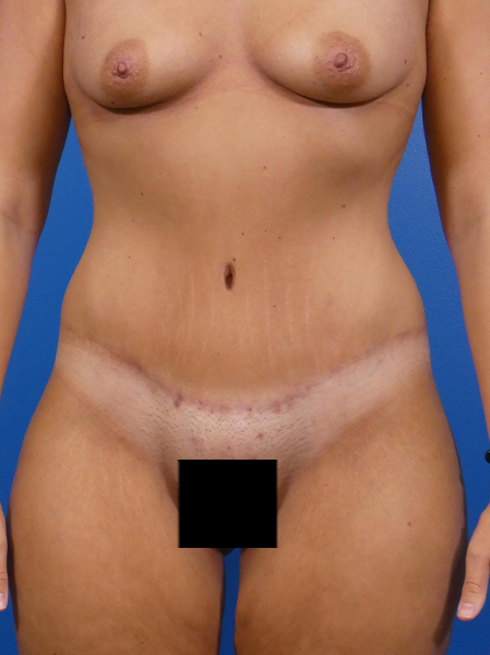 Tummy Tuck Before and After | Plastic Surgery Associates of Valdosta