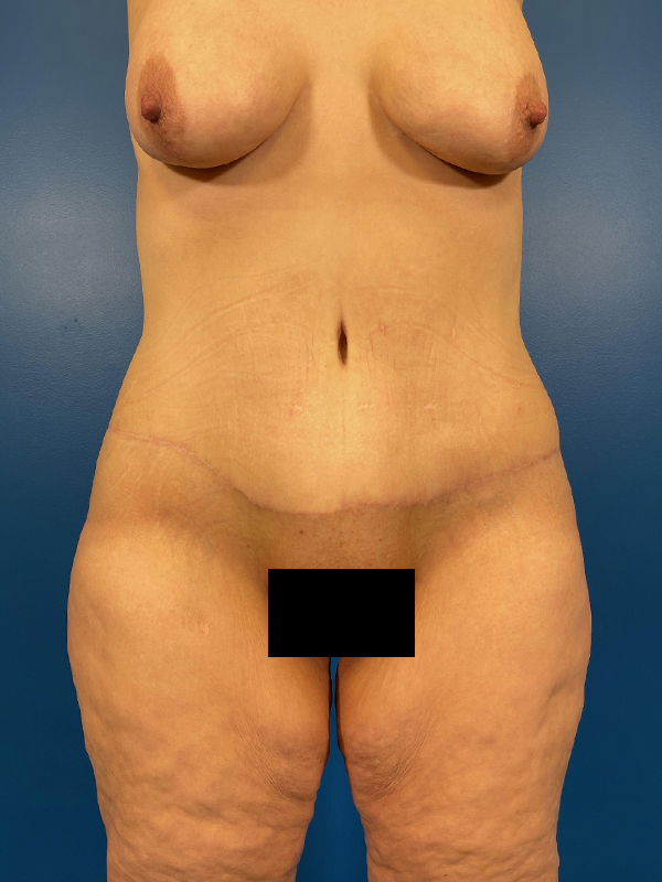 Tummy Tuck Before and After | Plastic Surgery Associates of Valdosta