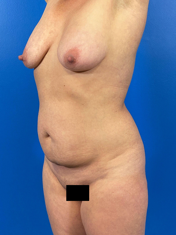 Tummy Tuck Before and After | Plastic Surgery Associates of Valdosta