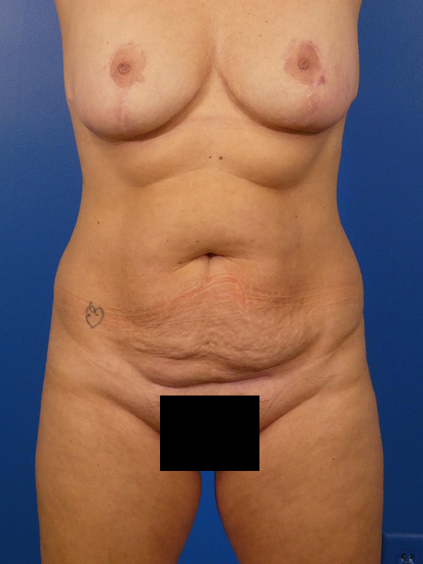 Tummy Tuck Before and After | Plastic Surgery Associates of Valdosta