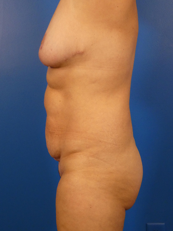 Tummy Tuck Before and After | Plastic Surgery Associates of Valdosta