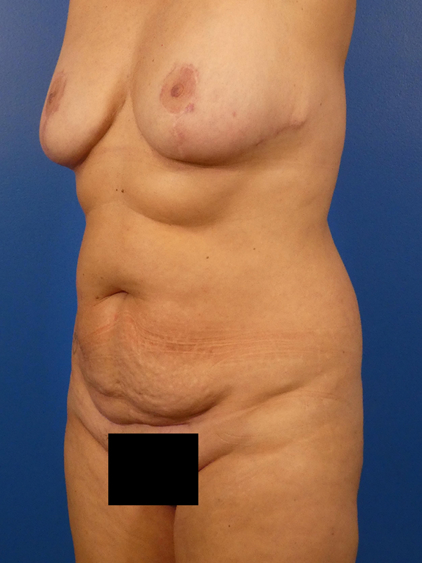 Tummy Tuck Before and After | Plastic Surgery Associates of Valdosta