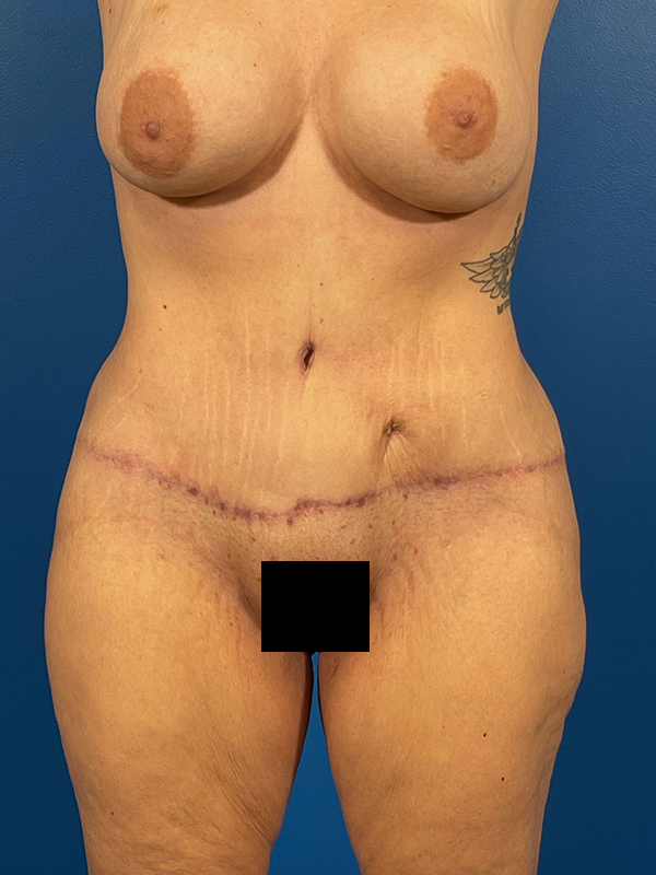 Tummy Tuck Before and After | Plastic Surgery Associates of Valdosta