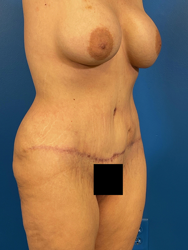 Tummy Tuck Before and After | Plastic Surgery Associates of Valdosta