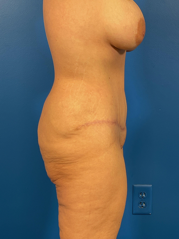 Tummy Tuck Before and After | Plastic Surgery Associates of Valdosta