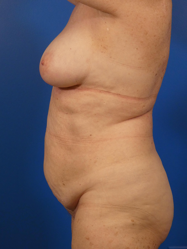 Tummy Tuck Before and After | Plastic Surgery Associates of Valdosta