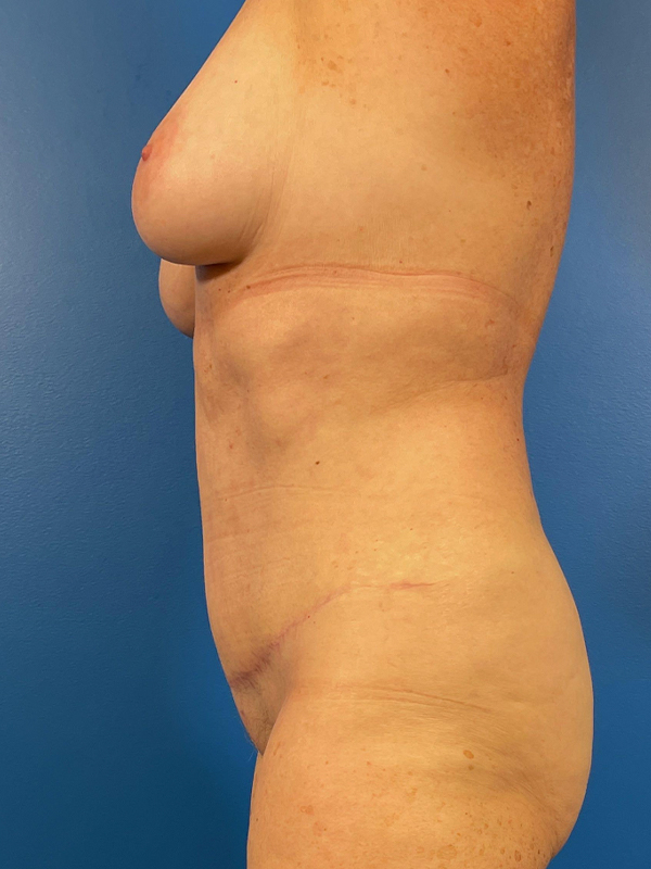 Tummy Tuck Before and After | Plastic Surgery Associates of Valdosta