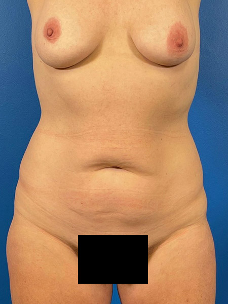 Tummy Tuck Before and After | Plastic Surgery Associates of Valdosta