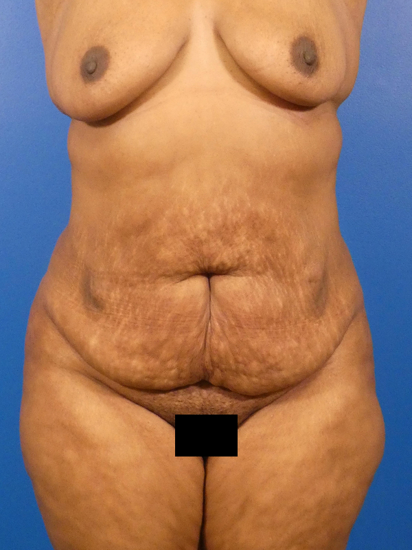 Tummy Tuck Before and After | Plastic Surgery Associates of Valdosta