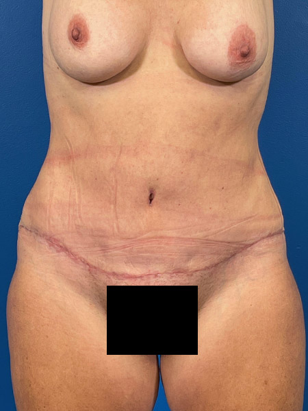 Tummy Tuck Before and After | Plastic Surgery Associates of Valdosta