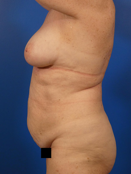 Tummy Tuck Before and After | Plastic Surgery Associates of Valdosta