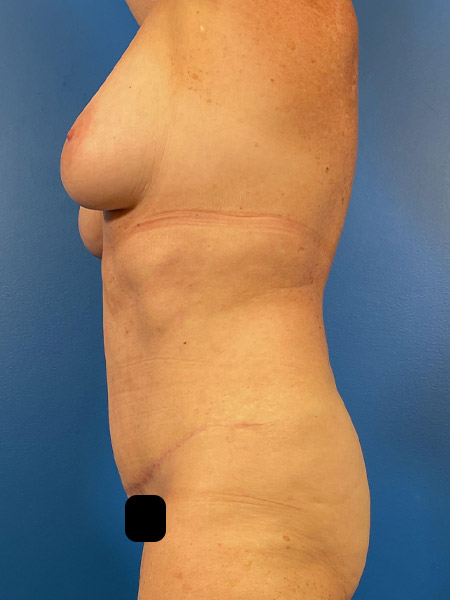 Tummy Tuck Before and After | Plastic Surgery Associates of Valdosta