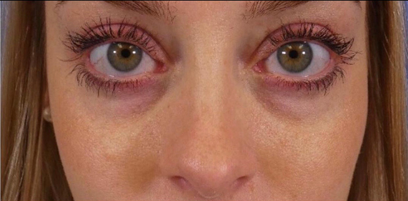 Under Eye Filler Before and After | Plastic Surgery Associates of Valdosta