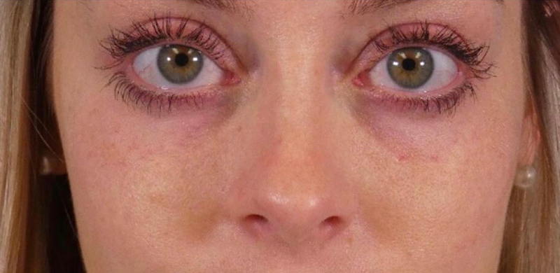 Under Eye Filler Before and After | Plastic Surgery Associates of Valdosta