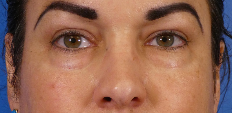 Under Eye Filler Before and After | Plastic Surgery Associates of Valdosta