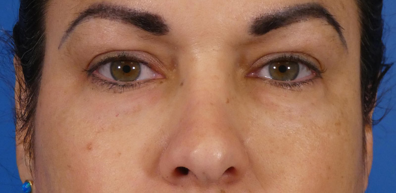 Under Eye Filler Before and After | Plastic Surgery Associates of Valdosta