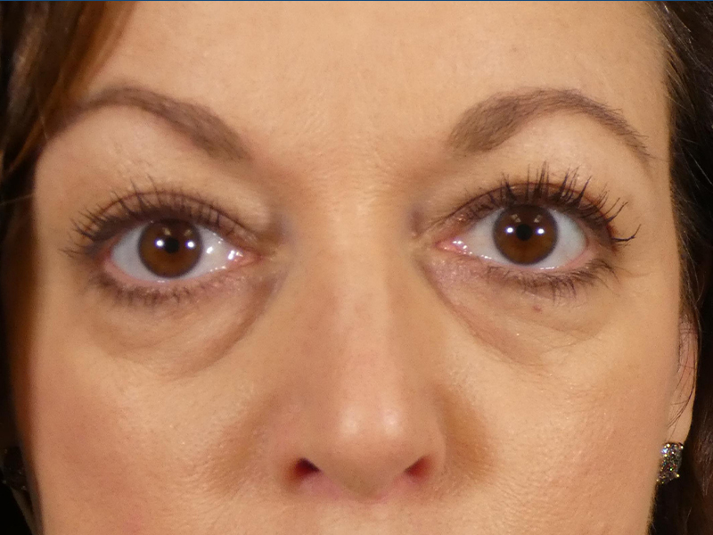 Under Eye Filler Before and After | Plastic Surgery Associates of Valdosta