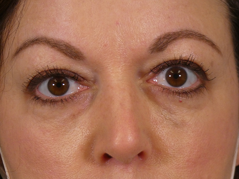 Under Eye Filler Before and After | Plastic Surgery Associates of Valdosta