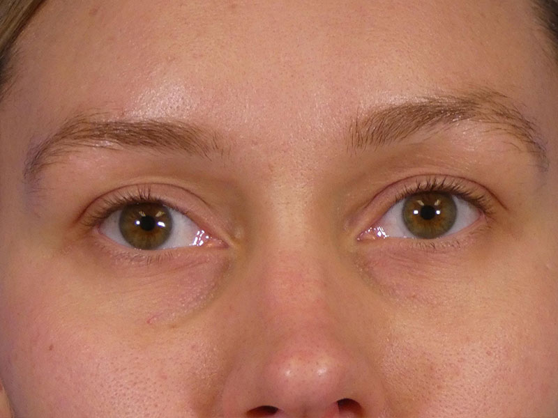 Under Eye Filler Before and After | Plastic Surgery Associates of Valdosta
