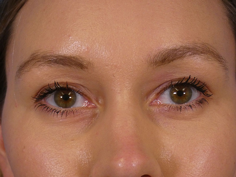 Under Eye Filler Before and After | Plastic Surgery Associates of Valdosta