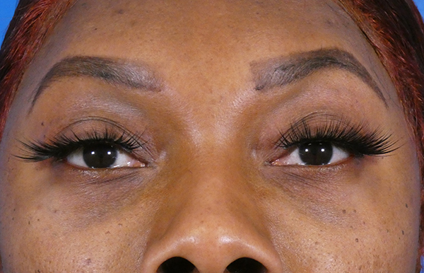 Under Eye Filler Before and After | Plastic Surgery Associates of Valdosta