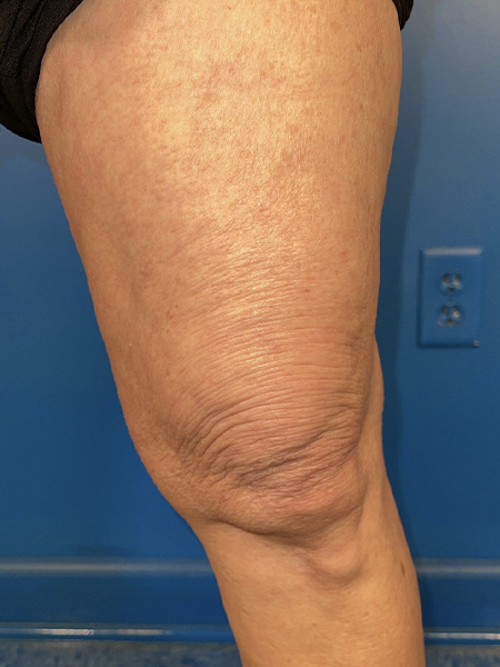 Virtue Rf Before and After | Plastic Surgery Associates of Valdosta